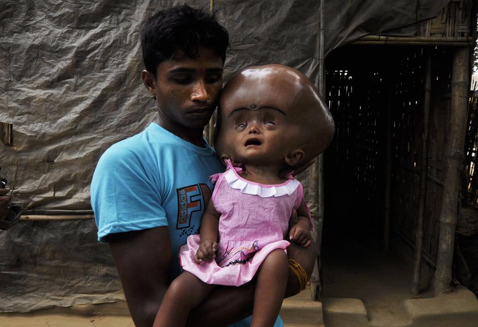 印度女童患脑积水 外形犹如外星人ET