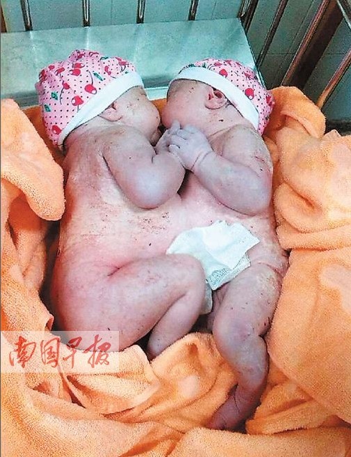 高清组图：广西首次成功分离连体婴儿