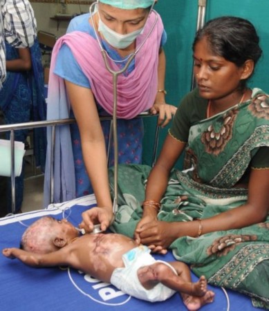 印度3月大男婴患怪病自燃4次 医生怀疑系汗液造成