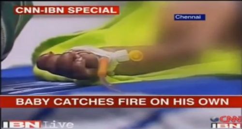 印度3月大男婴患怪病自燃4次 医生怀疑系汗液造成