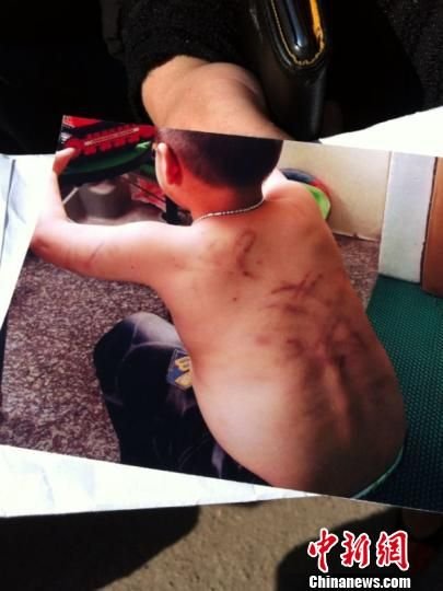 浙江4岁男童遭幼儿园老师暴打 遍体鳞伤