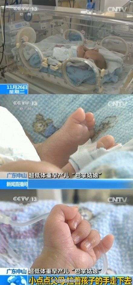 超低重早产儿“拇指姑娘”出生体重仅1斤1两(图)
