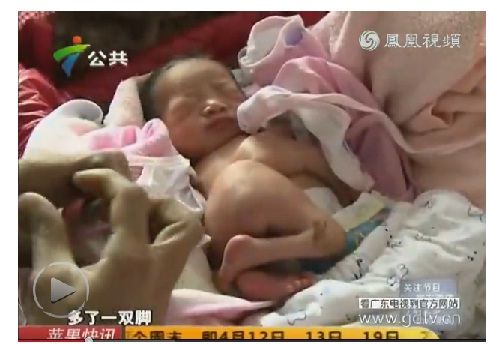 广东惠州新生儿长4手4脚 疑因生母孕时打针吃药