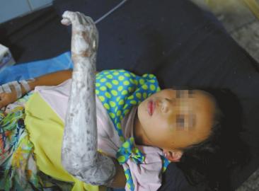 妈妈被困火海 6岁女儿抱其双腿往外拖被烧伤