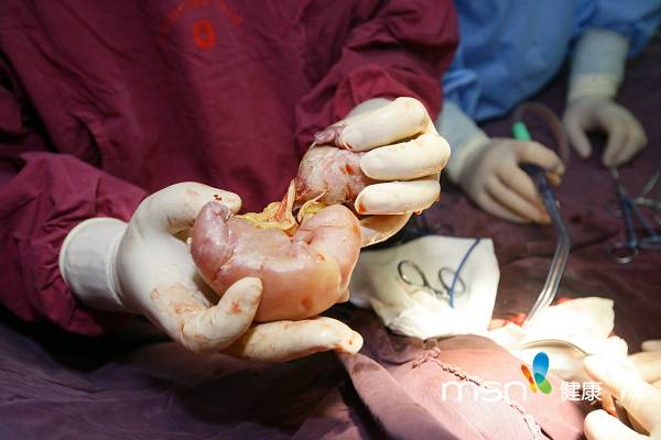 新生男婴腹中藏一胎儿 实拍手术