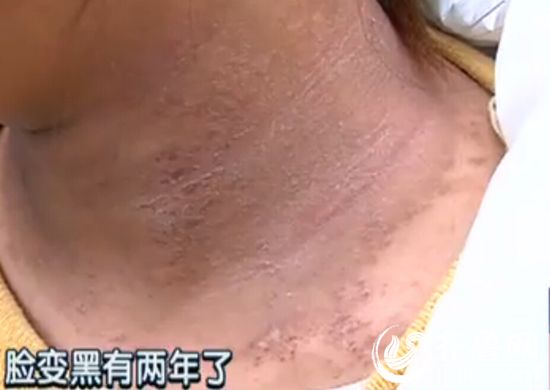 青岛25岁女子脸黑如“包公” 医生称是皮肤黑变病