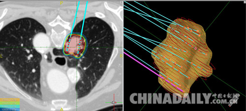 内外首例术中TPS计划联合3D打印模板肺癌粒子植入术在石成功