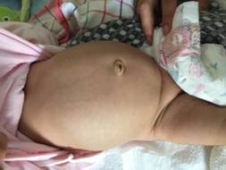 郑州市儿童医院成功实施河南首例新生儿腹腔镜下肾盂输尿管成形术