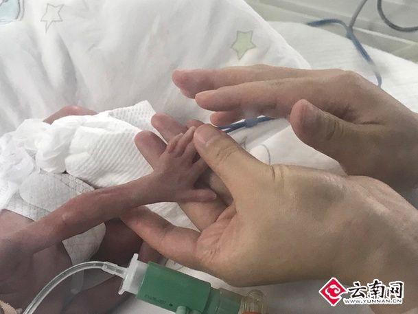 云南一早产男婴重度窒息 医生跪地抢救终脱险