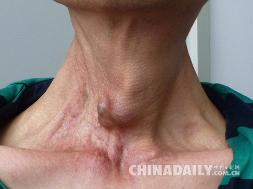 河北省人民医院放射性粒子植入癌灶挽回患者生命