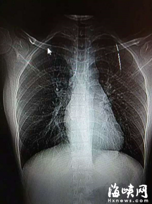 莆田19岁女孩咳嗽不止 胸腔取出5厘米长钢针(图)