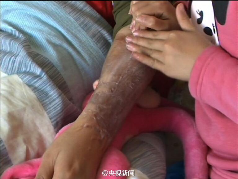 9岁女童为烧伤母亲撑起一片天